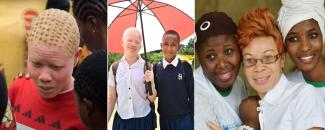 international-albinism-awareness-day-image