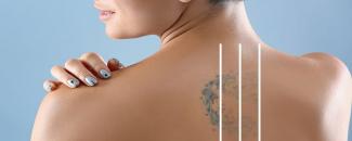 national-tattoo-removal-day-image